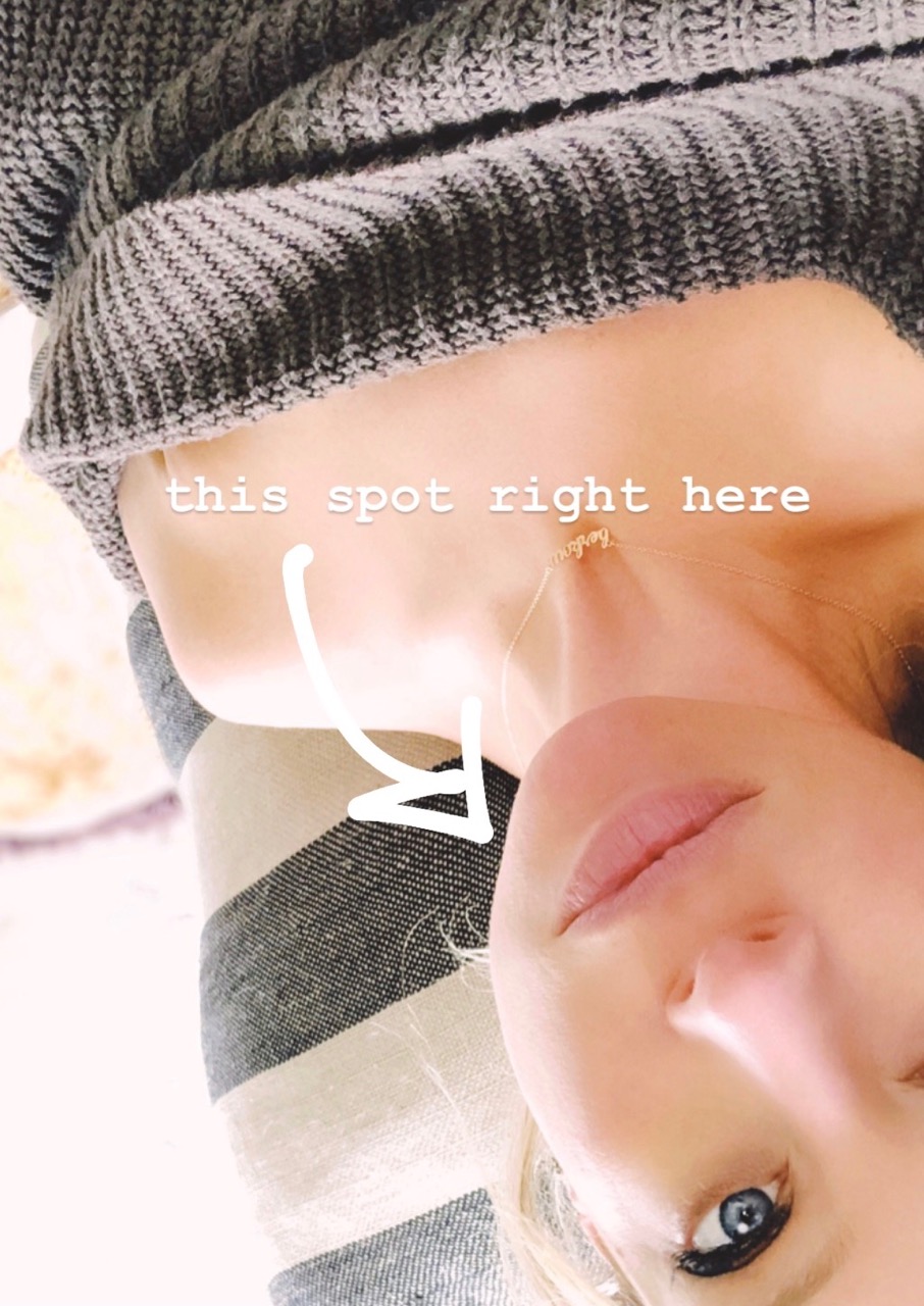 botox injections in jawline Nefertiti lift